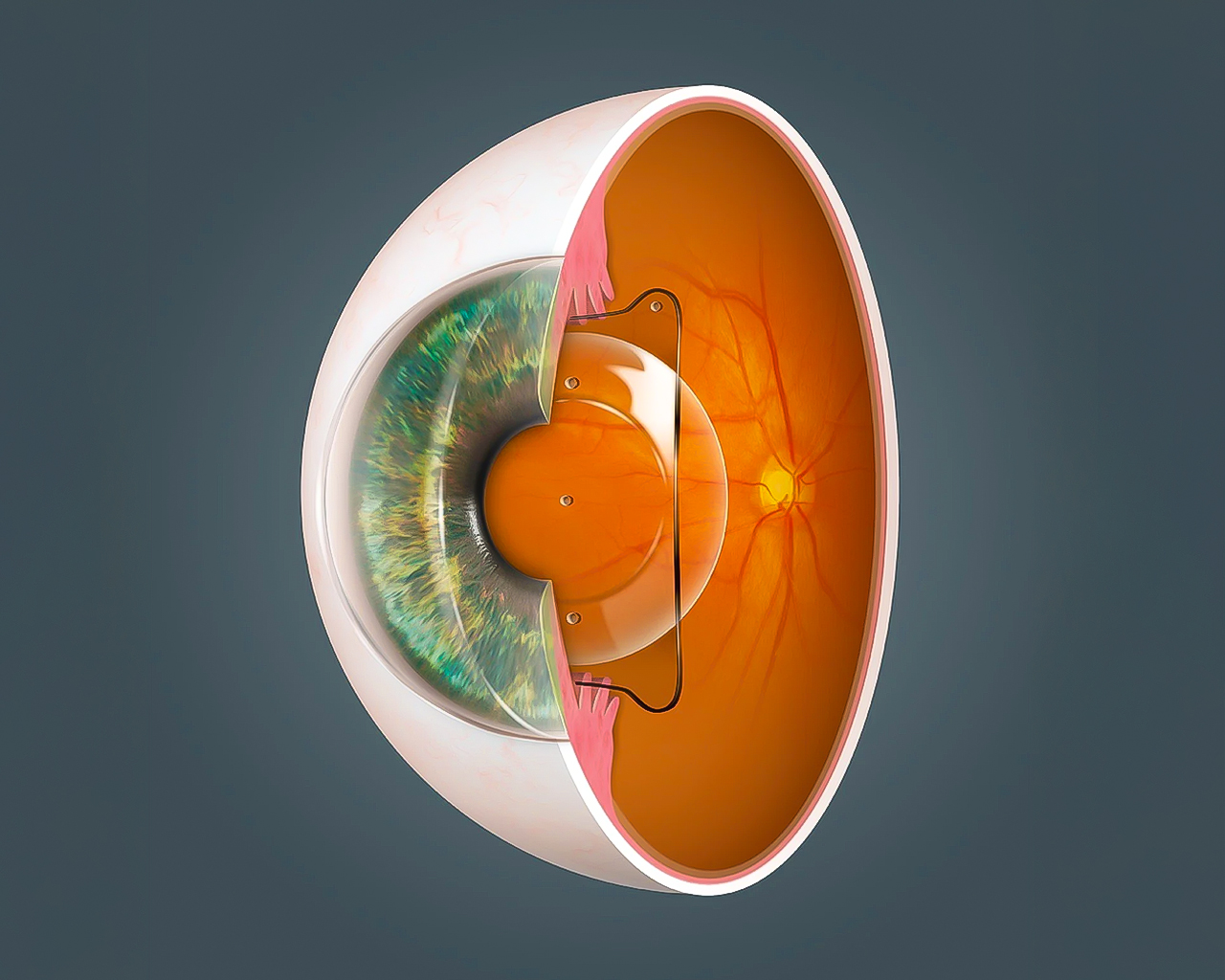Implantable Collamer Lens (ICL)