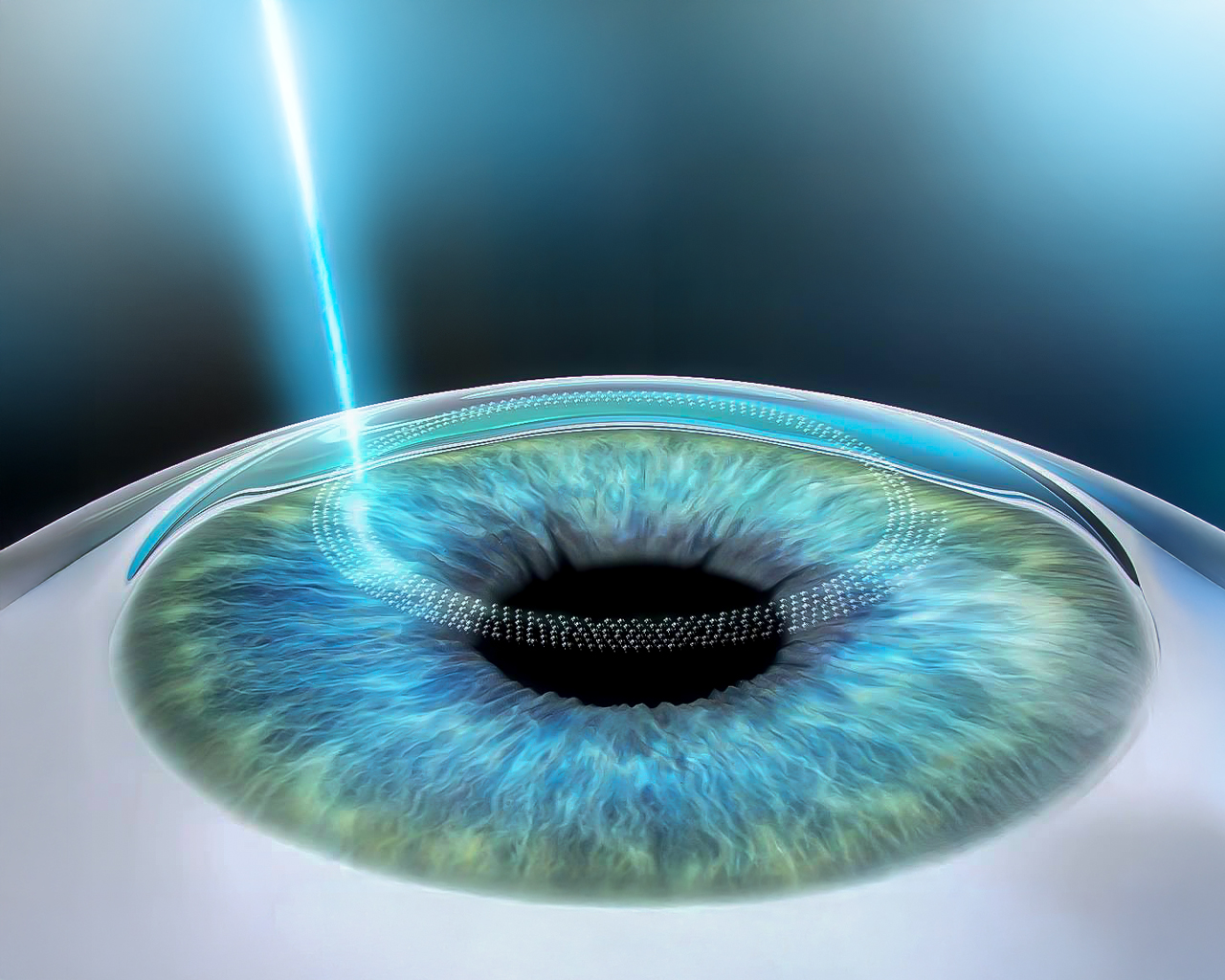 Femtosecond Laser (Femto-LASIK)