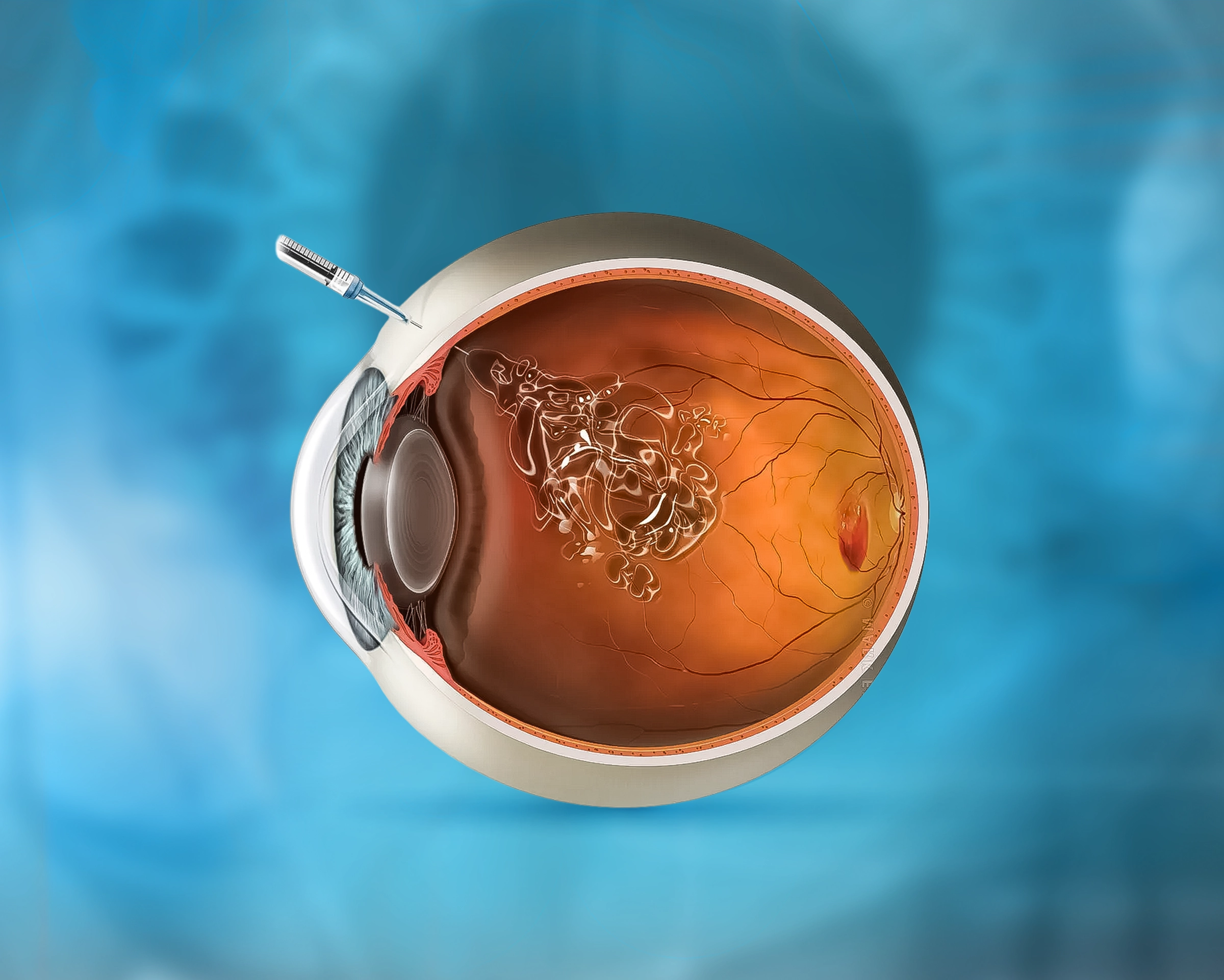 Intravitreal Injection